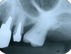 傾いた歯を起こす前のレントゲン写真