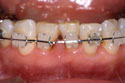 下の前歯の歯並びを直す治療中