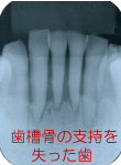 歯周病のレントゲン像