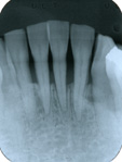 歯周病のレントゲン写真