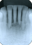 進行した歯周病のレントゲン写真