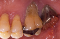 進行した歯周病の写真